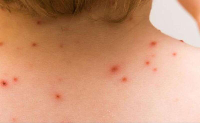 Imagen de archivo de unas pruebas de diagnóstico de viruela del mono / TA